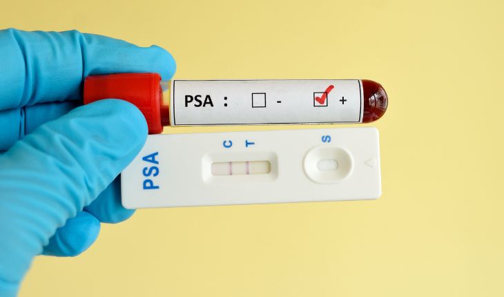 Crescimento benigno da próstata e a importância do exame PSA